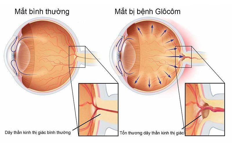 Phòng tránh nguy cơ mù lòa do bệnh lý glôcôm